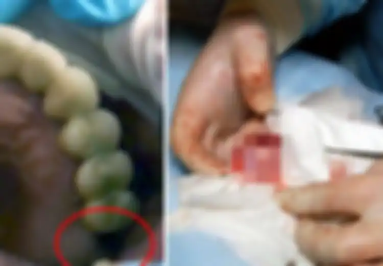 Hilang dari Rahang, Ternyata Gigi Geraham Seorang Bocah 13 Tahun Tumbuh di Dalam Alat Vitalnya
