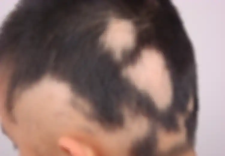 Menyisir Rambut Anak dan Temukan Kebotakan? Kenali Kelainan Alopesia Areata