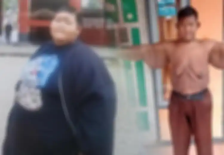 Akan Lakukan Operasi Gelambir Kulit, Mantan 'Bocah Raksasa' Aria Permana Harus Perhatikan Hal Ini