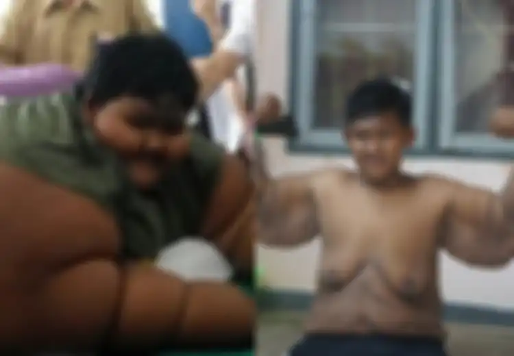 Arya Permana akan Jalani Operasi Pengangkatan Gelambir, Ini Operasi Baratrik yang Berhasil Turunkan Berat Badannya dari 192 Kg Jadi 85 Kg