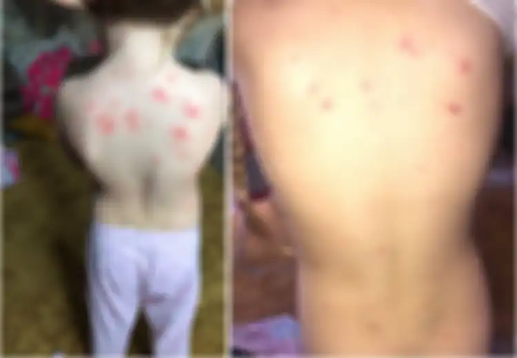 Ibu Muda Ini Sembuhkan Anaknya dari Cacar Air Hanya dengan Sampo, Rupanya Kandungan Ini Manjur Hilangkan Gatal dan Bintik Merah