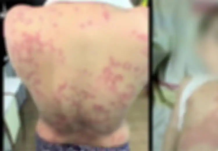 Bayi Ini Tertular Alergi Kulit Lewat ASI Karena Produk Pemutih Palsu yang Dipakai Ibunya, Peringatan Bagi Orangtua!