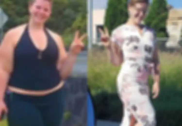 Alami Kaki dan Paha Bengkak Karena Lipoedema, Akhirnya Wanita Ini Pede Bisa Pakai Celana Pendek