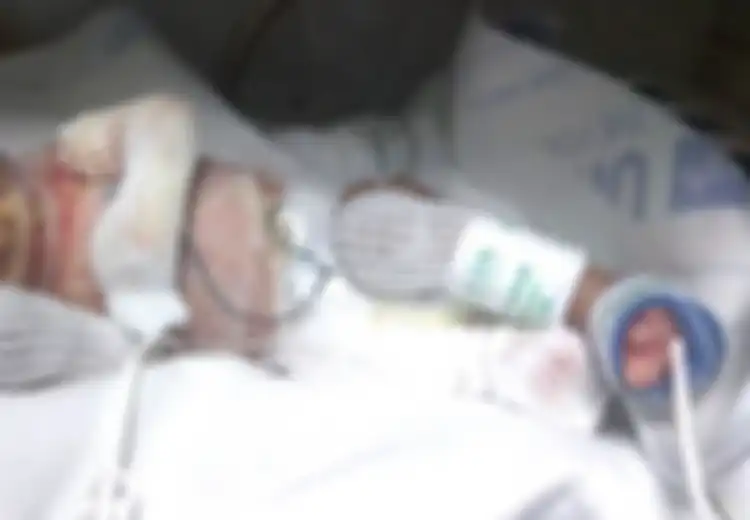 Cerita Ibu yang Lahirkan Bayi yang Lahir Tanpa Kulit, ‘Dia Tak Seperti Bayi, Tapi Terlihat Seperti Daging’