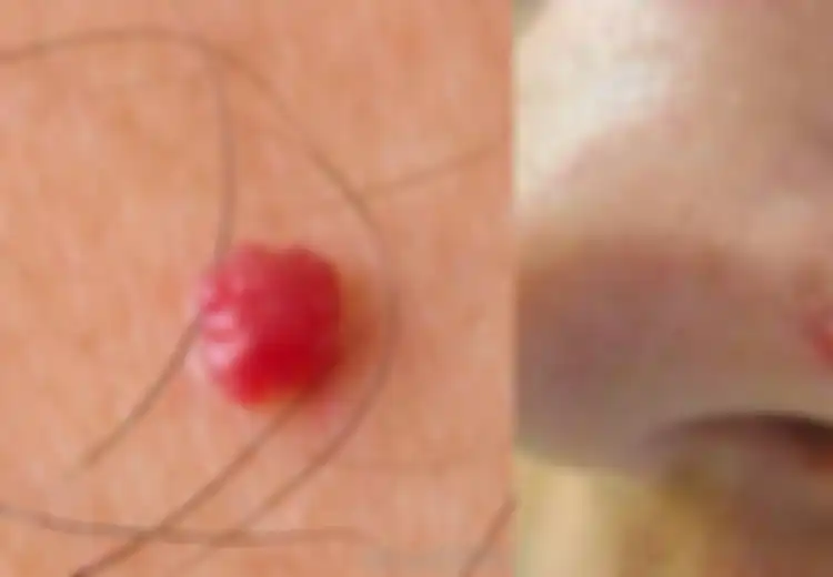 Punya Benjolan Mirip Tahi Lalat Berwarna Merah Seperti Ini? Jangan Khawatir, Ini Artinya
