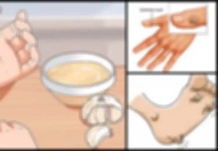 5 Cara Alami Hilangkan Kutil Hingga Tak Bersisa, Termasuk dengan Bawang Putih dan Nanas, Yuk Coba!
