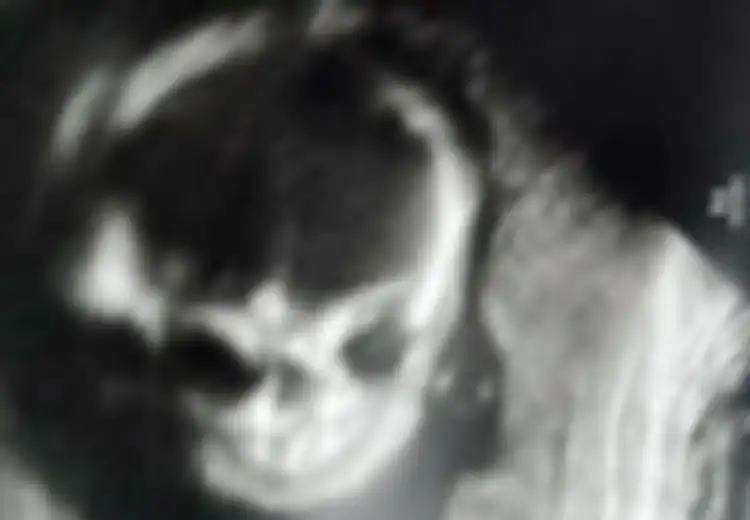 Tampak Mengerikan Sampai Ibunya Ketakutan di Ultrasound, Beginilah Kondisi Bayi Ini Setelah Dilahirkan