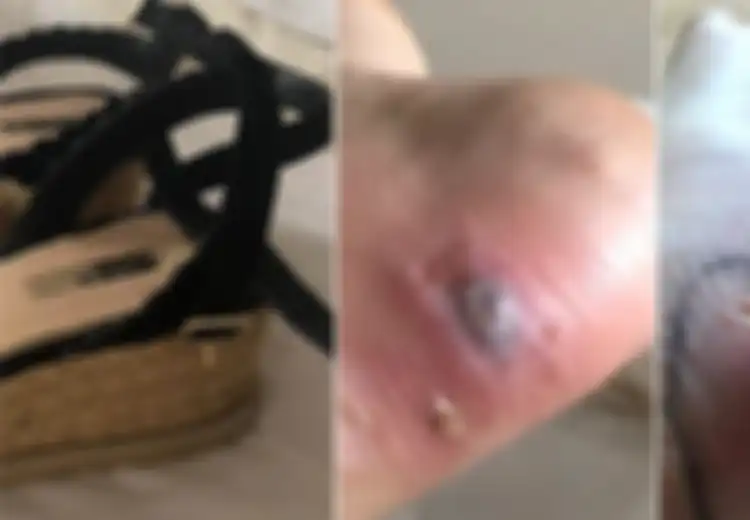 Wanita Ini Nyaris Meninggal Akibat Infeksi yang Disebabkan Sepatu dengan Model Seperti Ini