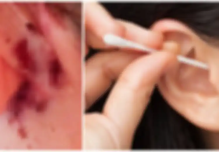 Mengerikan, Gara-gara Sering Pakai Cotton Bud, Wanita Ini Alami Infeksi Otak hingga Gerogoti Tengkorak Belakang Telinga
