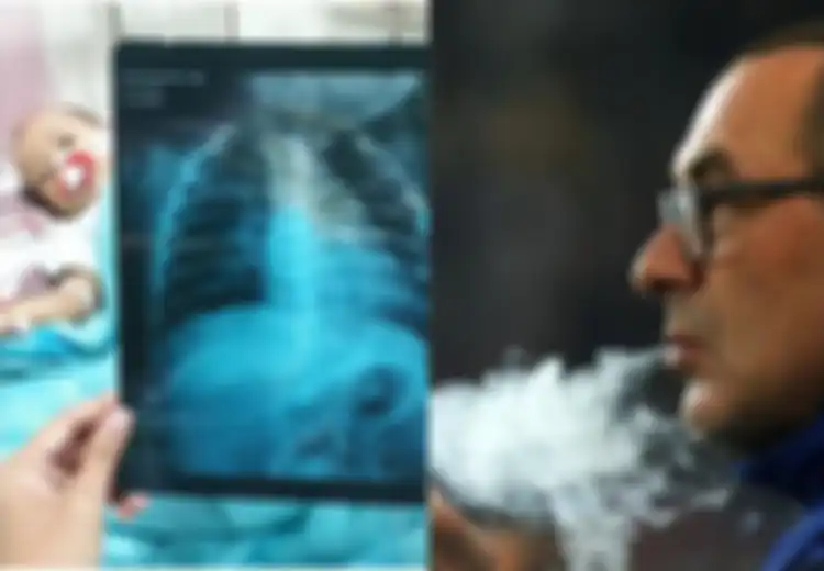 Peringatan! Pneumonia Seperti yang Diidap Maurizio Sarri Juga Bisa Diidap oleh Anak dari Ayah Perokok