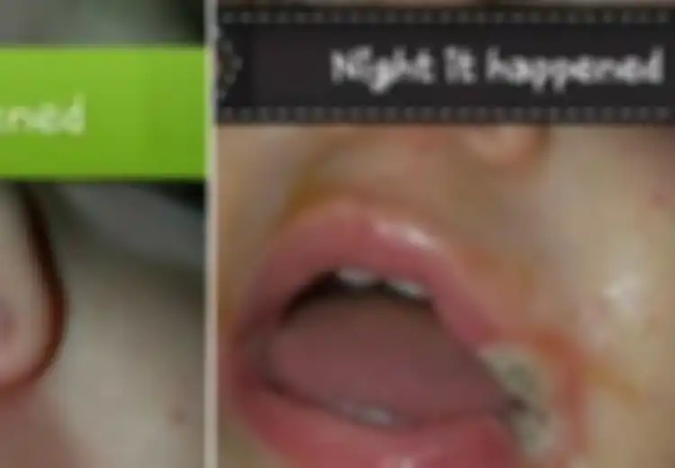 Mulut Anak Ini Melepuh Karena Charger Ponsel, Peringatan Buat Orangtua Agar Tidak Sembarangan Menaruhnya