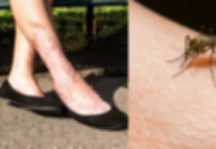 Akibat Digigit Nyamuk, Kaki Wanita Ini Membengkak hingga Detak Jantungnya Berhenti Tiba-tiba, Ternyata Ini yang Terjadi