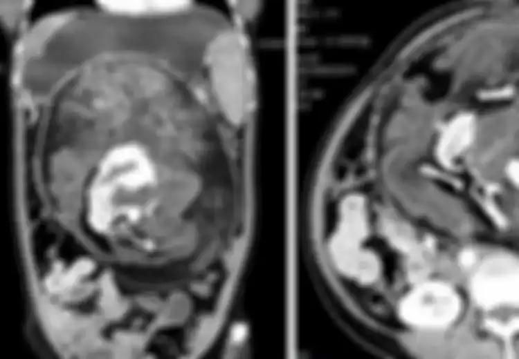 Bukan Seorang Kanibal, Dokter Temukan Massa Tulang Hingga Rambut Manusia di Perut Gadis 17 Tahun, Ternyata Hal Ini yang Dialaminya