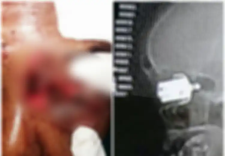 Masak Kacang dengan Panci Presto, Seorang Wanita Jadi Buta, saat Peluit Presto Berubah Bak Peluru