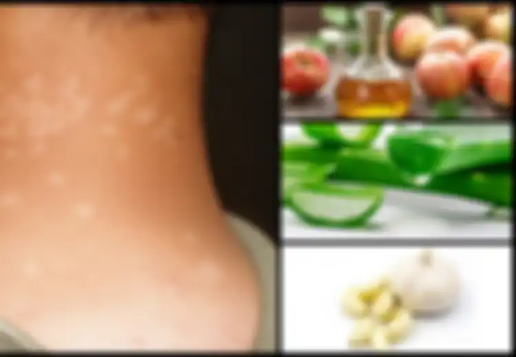 Termasuk Konsumsi 2 Siung Bawang Putih dengan Air Hangat Setiap Hari, Simak 5 Cara Obati Panu Secara Alami!