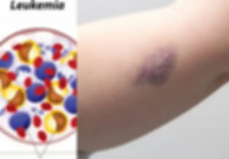Sering Kita Abaikan, Ini 5 Gejala Leukemia, Salah Satunya Memar