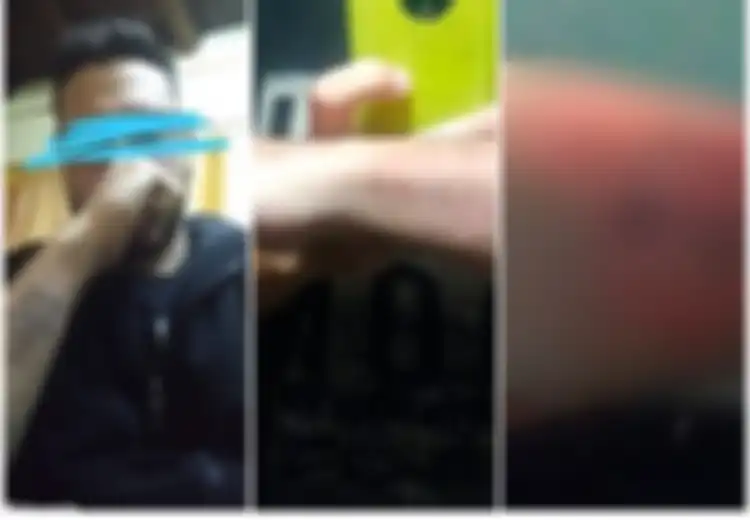 Ingin Masuk Kepolisian, Pemuda Ini Nekat Hapus Tato dengan Cara Sederhana Terinspirasi dari Video Tutorial, Tapi Begini Jadinya