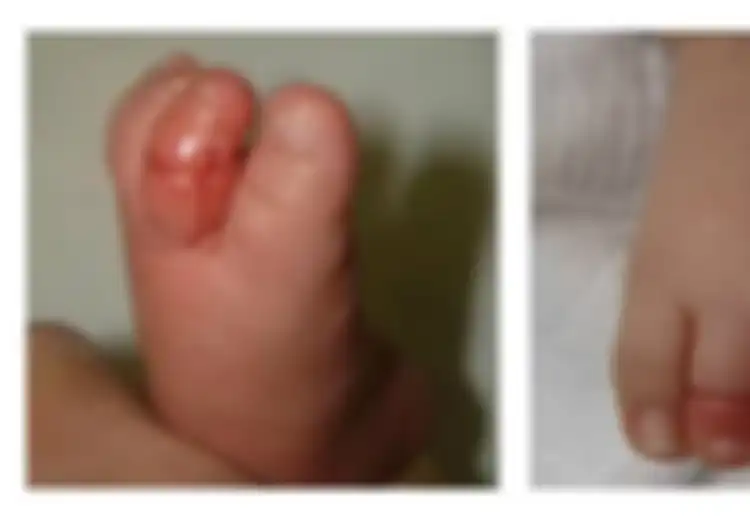 Peringatan Buat Orangtua! Bayi Ini Hampir Kehilangan Jari Kakinya Hanya Gara-gara Ini