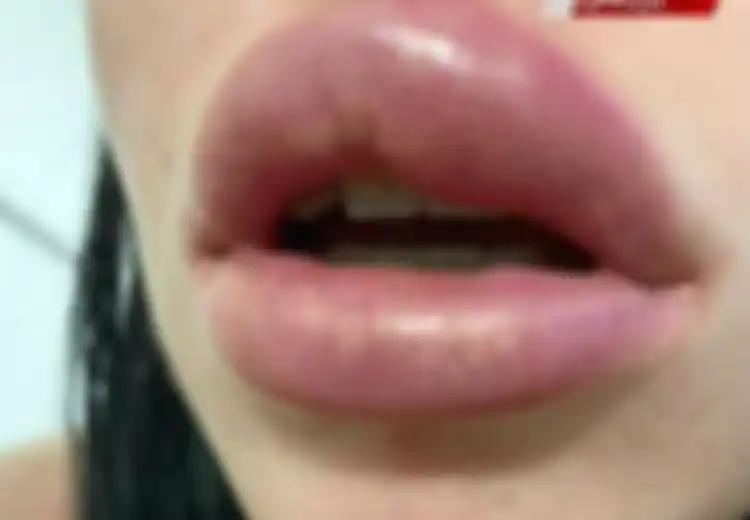 Setelah Suntik Filler Bibir di Klinik, Bibir Wanita Ini Pecah hingga Hampir Buta, Waspadai Penyebabnya
