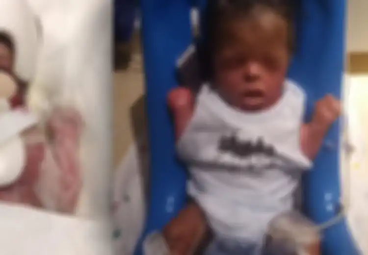 Perjuangan Hidup Bayi Ja'bari, Lahir Tanpa Kulit dengan Berat 1,12 kg hingga Berhasil Tertutup Kulit Sepenuhnya dan Beratnya Jadi 6,7 kg