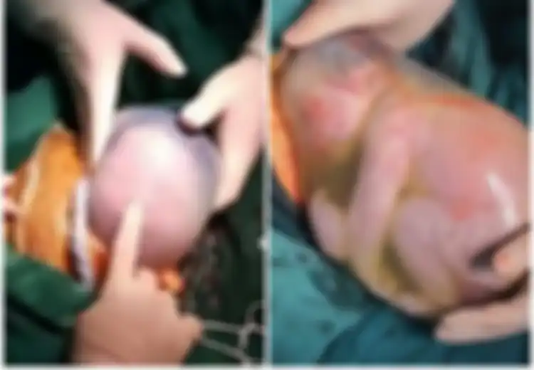 Bayi Laki-laki Ini Dilahirkan dalam Keadaan Masih Terbungkus Kantung Ketuban, Diangkat dengan 'Damai' dari Perut Ibunya