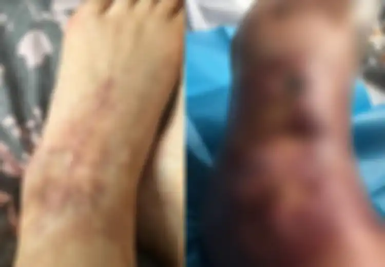 Wanita 41 Tahun Ini Nyaris Kehilangan Kakinya Setelah Alami Infeksi Membusuk Saat Berada di Tepi Kolam Renang Karena Hal Ini