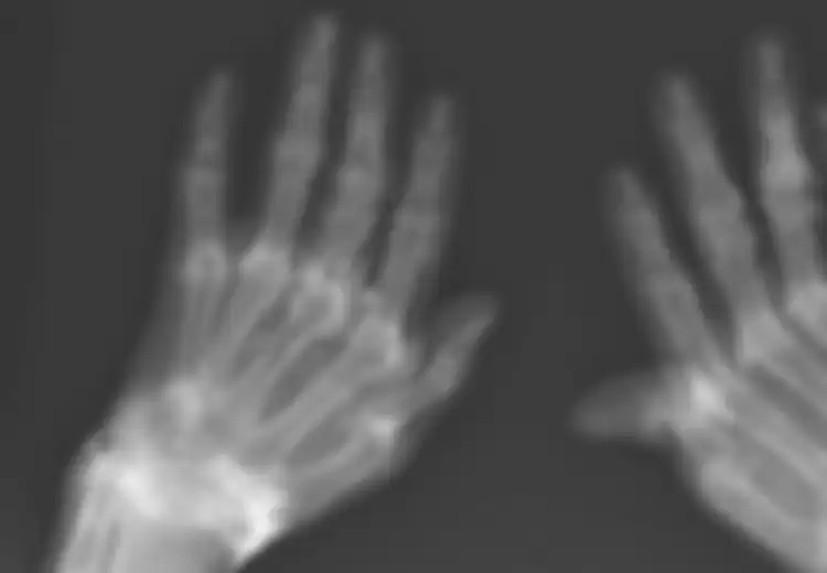 Alami Nyeri Sendi Kronis Selama 40 Tahun, Saat Lakukan X-Ray Ditemukan Serpihan Emas di Dalam Sendi Wanita Ini, Kok Bisa?