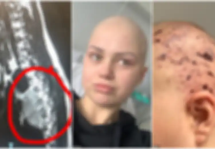 Awalnya Sakit Punggung, Ibu Muda Ini Didiagnosis Kanker Langka yang Biasanya Menyerang Anak-anak Usia di Bawah 5 Tahun