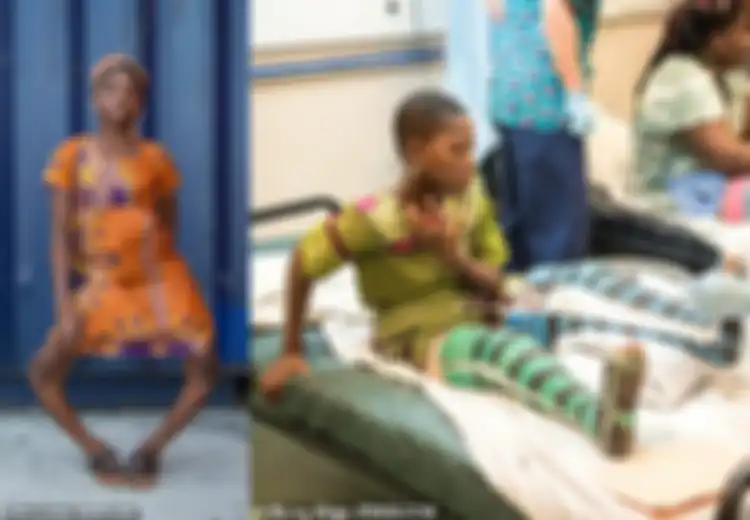 Diejek dan Keluar dari Sekolah Karena Kaki Bengkok Parah, Lihatlah Tampilan Menakjubkan Gadis Ini Setelah Dioperasi