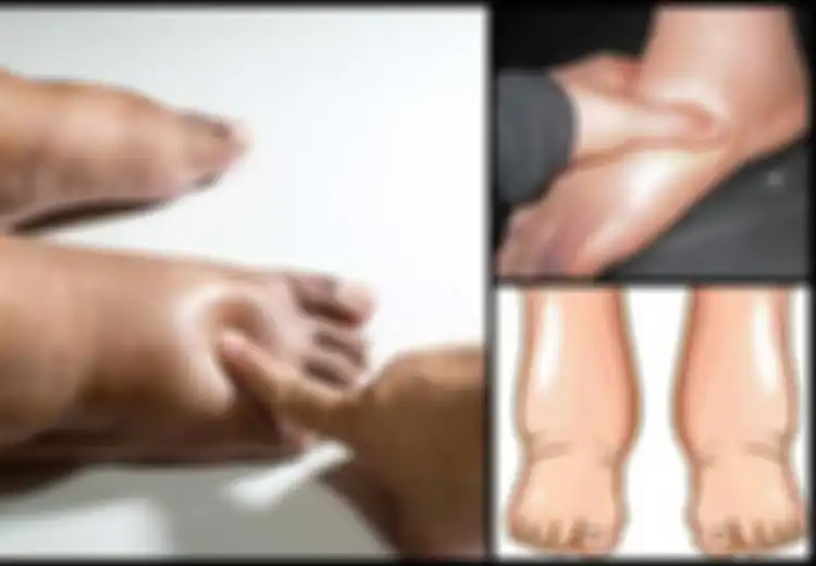 7 Penyebab Pergelangan Kaki atau Kaki Membengkak, Termasuk Awal dari Penyakit Ini, Kenali Gejala dan Penyebab-penyebabnya!