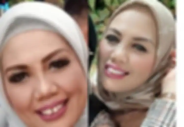Ely Sugigi Potong Gigi Bagian Depannya: Ini Efek Samping Potong Gigi Menurut Dokter