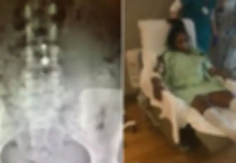 Gunakan KB Spiral, Wanita  Ini Mengalami Nasib Mengenaskan, Indung Telurnya yang Menghitam Diangkat Organ Tubuhnya tak Berfungsi hingga Amputasi