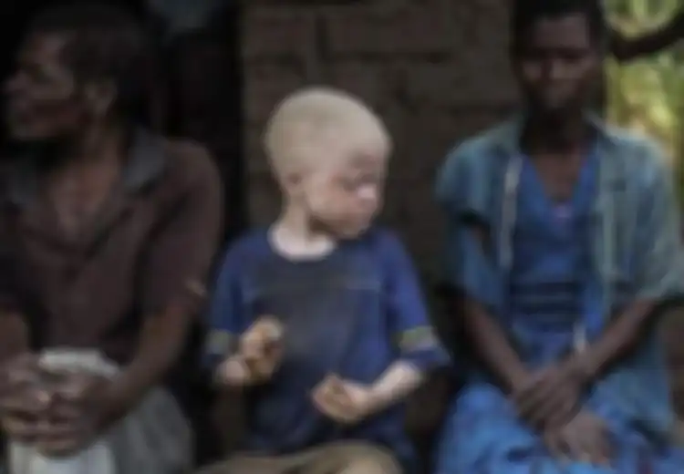 Begilah Nasib Mengerikan yang Dialami Bocah Kulit Putih yang Terlahir dari Orang Tua Kulit Hitam di Afrika, Diangap Keramat Mereka Diperlakukan Begini