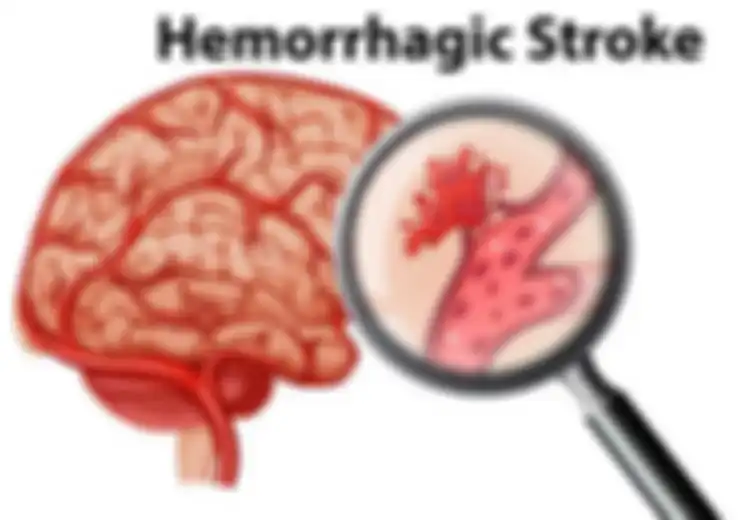 Makan Korban Banyak Orang Termasuk Artis, Ternyata Satu Bulan Sebelum Stroke Tubuh Akan Mengirimkan Tanda Peringatan Ini