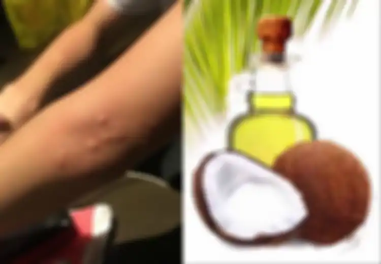 Ini 10 Obat Biduran Rumahan, Salah Satunya Minyak Kelapa, Mau Coba?