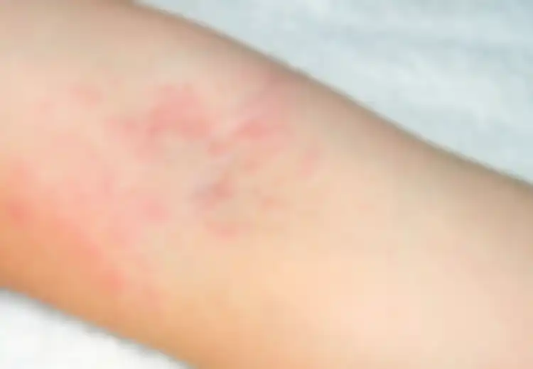 Punya Sakit Kulit, Dokter Justru Temukan Ratusan Pasien ini Terserang Virus Corona, Bagaimana Bisa?