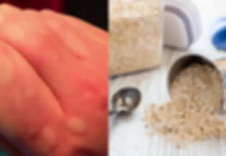 Obat Biduran yang Ampuh, Termasuk Berendam dalam Oatmeal dan Juga Ini!