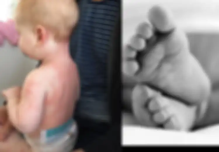 Alami Ruam di Sekujur Tubuhnya, Bayi 8 Bulan Ini Meninggal Karena Penyakit Kawasaki, Dokter Duga Juga Terkait Virus Corona