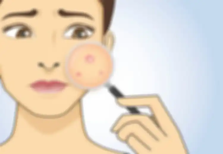 3 Cara Menghilangkan Kutil di Wajah Agar Para Wanita Tidak Lagi Minder