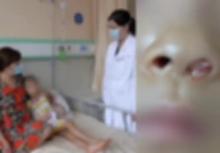 Gara-gara Tersandung dan Jatuh, Bocah ini Ngeluh Susah Bernapaas, Setelah Diperiksa Dokter Temukan ini di Hidungnya