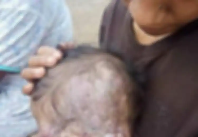 Mengira Bintik Merah di Pelipis Kiri Anaknya hanya Gigitan Nyamuk, Hancurlah Hati Pasangan Ini Mengetahui Bayinya Ternyata Idap Penyakit Ini