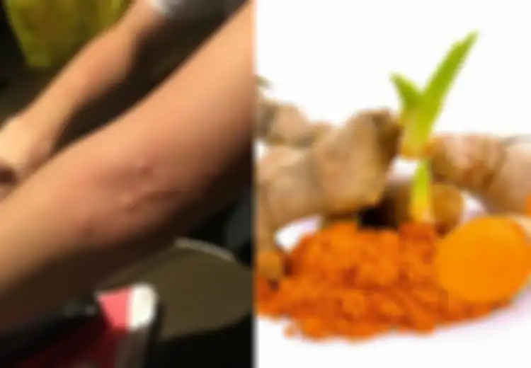 Obat Biduran Rumahan yang Mudah Didapat Bahkan Ada di Dapur Kita