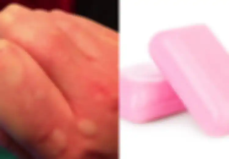 9 Cara Sebagai Obat Biduran Kronis yang Instan, Sabun Tanpa Wangi!