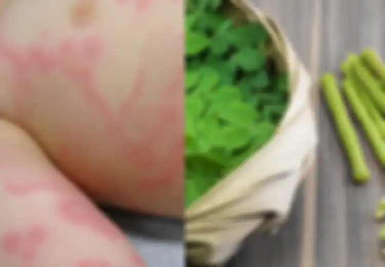 Coba Obati Biduran dengan Antihistamin Alami Termasuk Daun Kelor