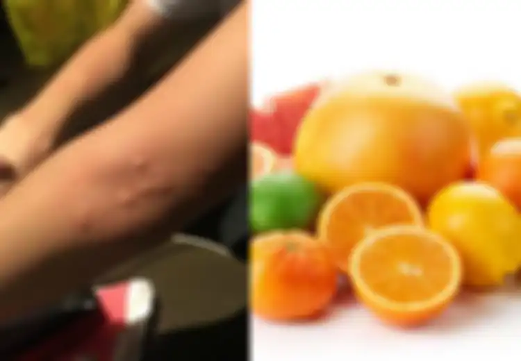 Obat Biduran dengan Makanan yang Baik dan Buruk Melawan Alergi