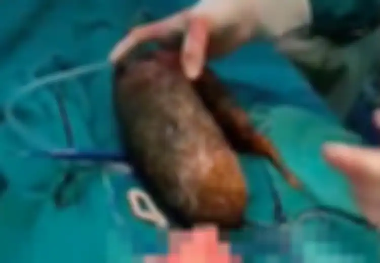 Mengeluh Sakit, Setelah Dioperasi Dokter Temukan Gumpalan Mengerikan Seberat 7 Kg di Perut Gadis Ini, Terungkap Kebiasaan Aneh yang Dilakukannya Sejak Kecil