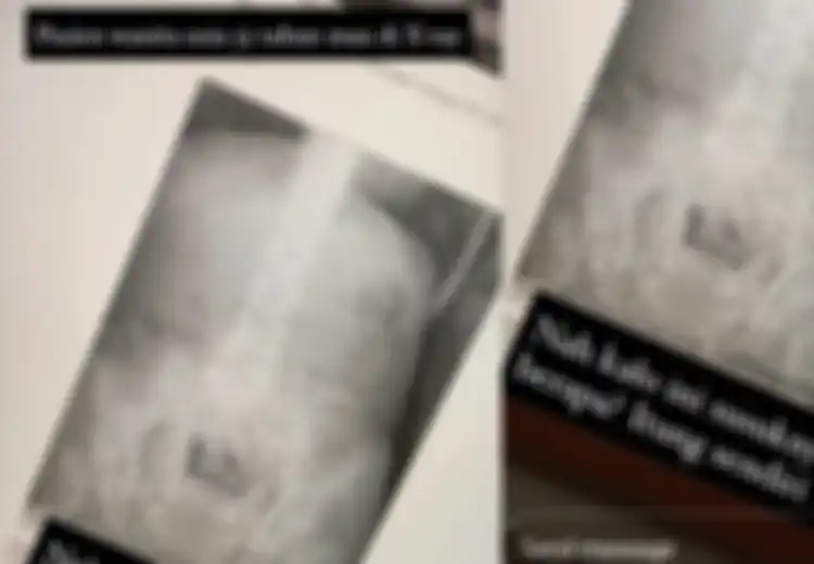 Viral X-ray Pasien Wanita Usia 55 Tahun Dipenuhi Susuk: Benarkah Susuk Mampu Ubah Pemakainya Jadi Cantik?