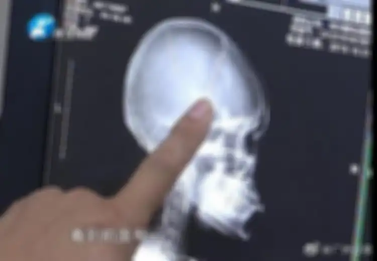 Lakukan CT Scan pada Kepalanya Setelah Kecelakaan, Wanita Ini Malah Temukan 2 Jarum di Dekat Otaknya