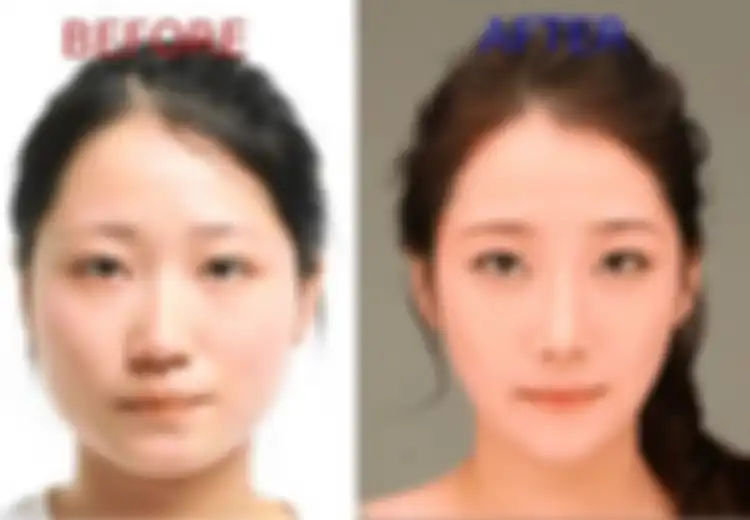 Benarkah Semakin Cantik? Ini 6 Operasi Plastik yang Paling Terkenal dan Sering Dilakukan di Korea Selatan