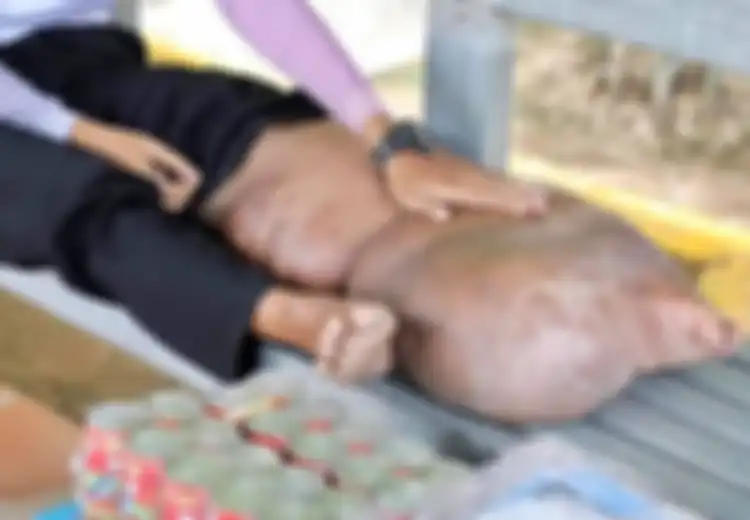 Abaikan Luka Biasa Saat Masih Kecil, Kaki Pria Ini Membengkak Hingga Seukuran Babi Kecil Selama Lebih dari 20 Tahun dan Tak Bisa Disembuhkan, Ternyata Inilah Penyebabnya